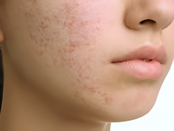 acne
