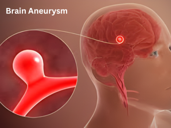 aneurysms