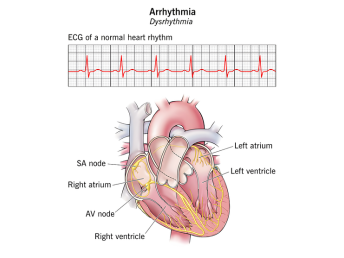 arrhythmia