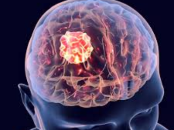 brain tumors ​