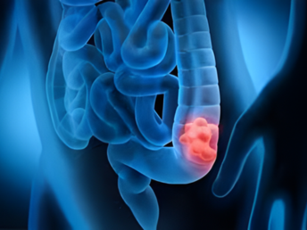colon polyps & cancer ​