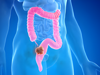 colorectal cancer ​