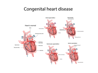 congenital heart disease