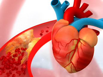 coronary artery disease