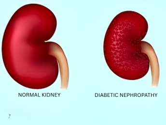 diabetic nephropathy ​