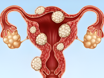 fibroids ​