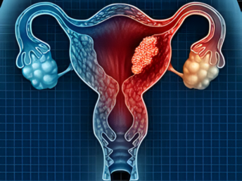 gynecologic cancers​