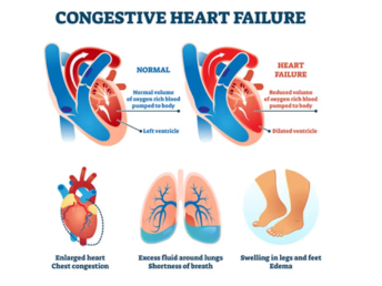 heart failure