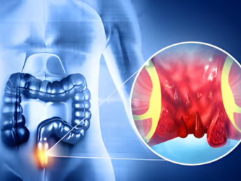 hemorrhoids ​