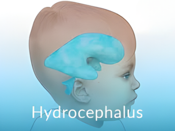 hydrocephalus​