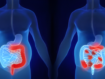 inflammatory bowel disease (ibd) ​