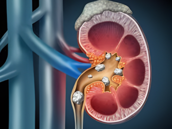 kidney stones ​