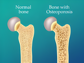 osteoporosis​