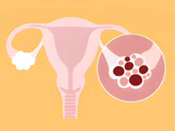 polycystic ovary syndrome (pcos)​