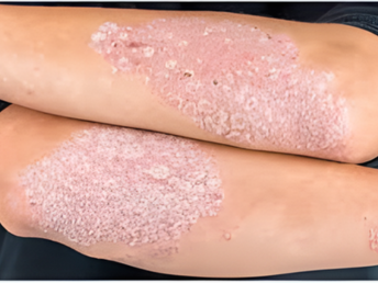 psoriasis