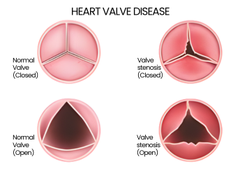 valvular heart disease