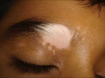 vitiligo