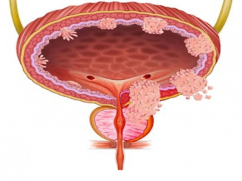 bladder cancer canva