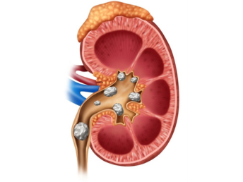kidney stone canva