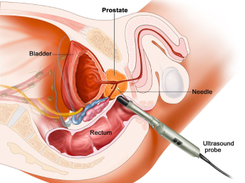 prostage disorder2 canva