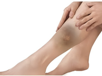 soft tussue injuries canva