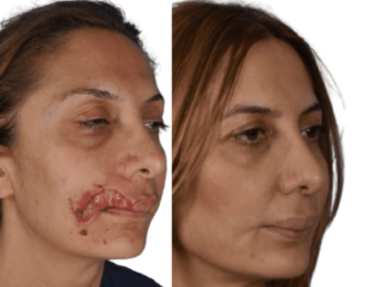 trauma reconstruction image canva