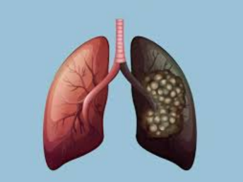 lung cancer